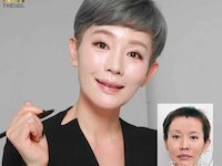 До и После ( Нитевой лифтинг лица "THE UP" лица в Корее)