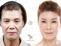 До и После ( Нитевая подтяжка лица в Корее )
